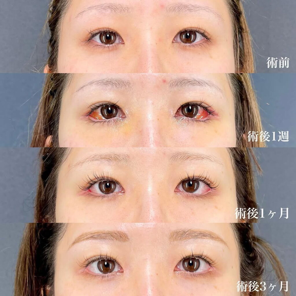 白目拡大術 裏ハムラ 目頭切開 症例