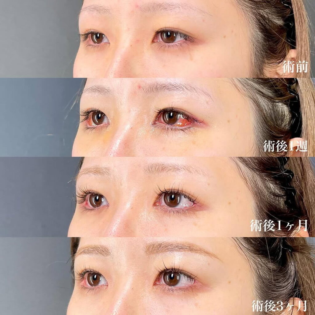 白目拡大術 裏ハムラ 目頭切開 症例