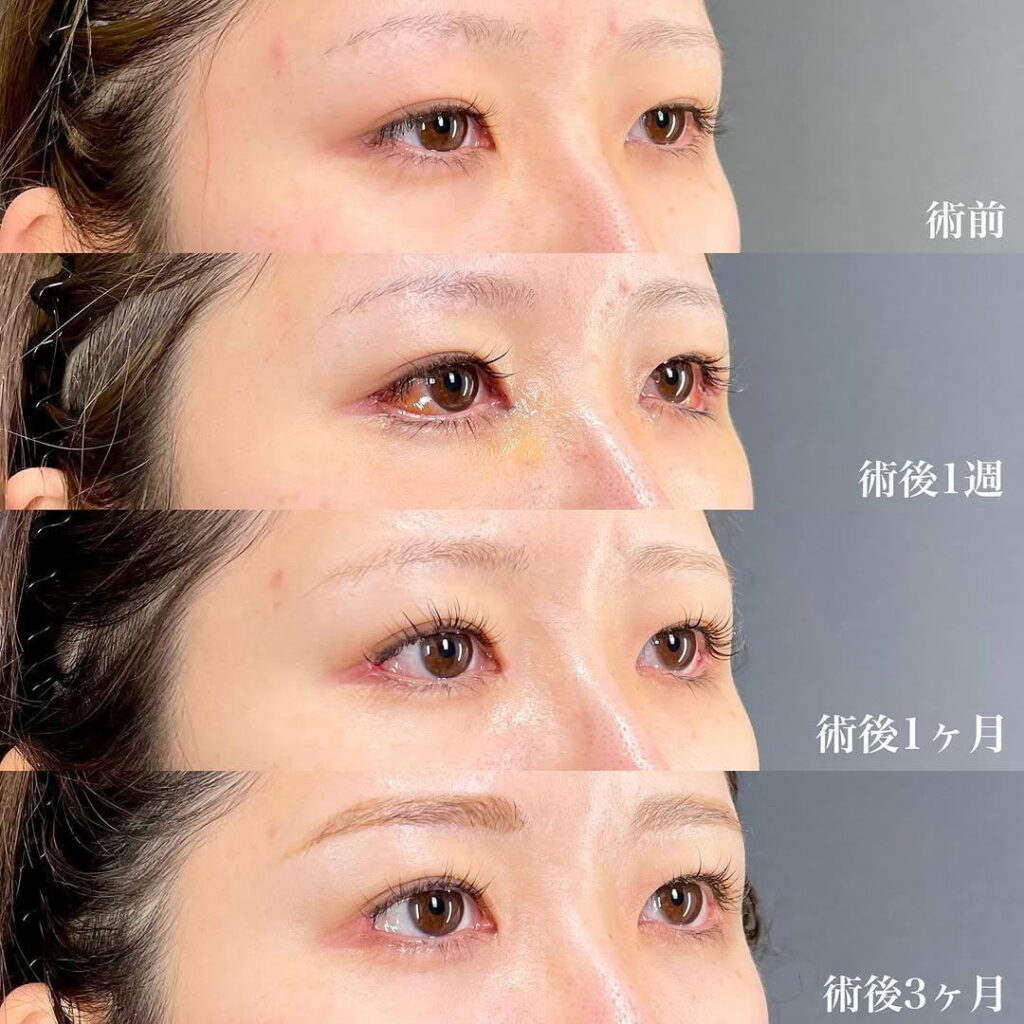 白目拡大術 裏ハムラ 目頭切開 症例