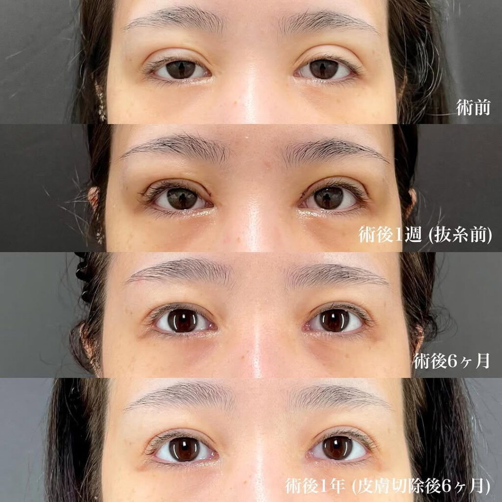 眼瞼下垂 二重修正 症例