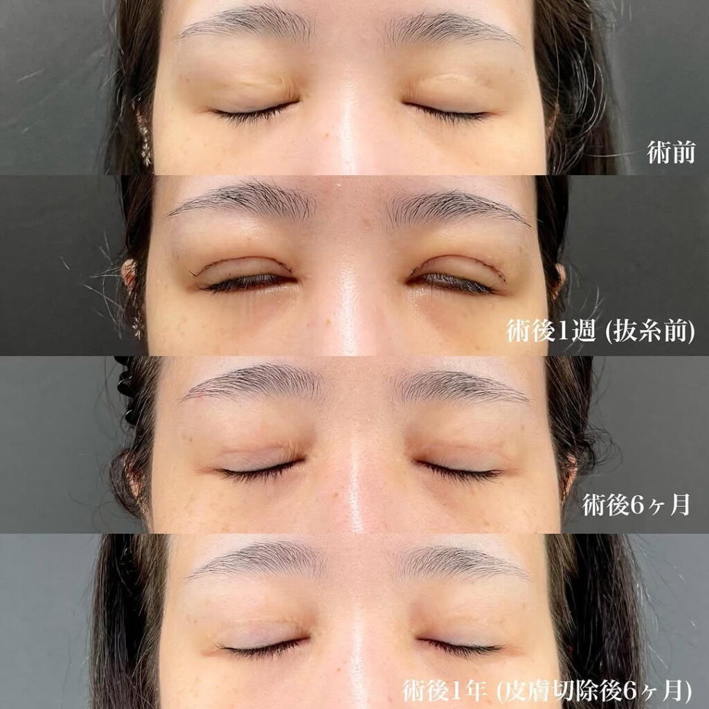 眼瞼下垂 二重修正 症例