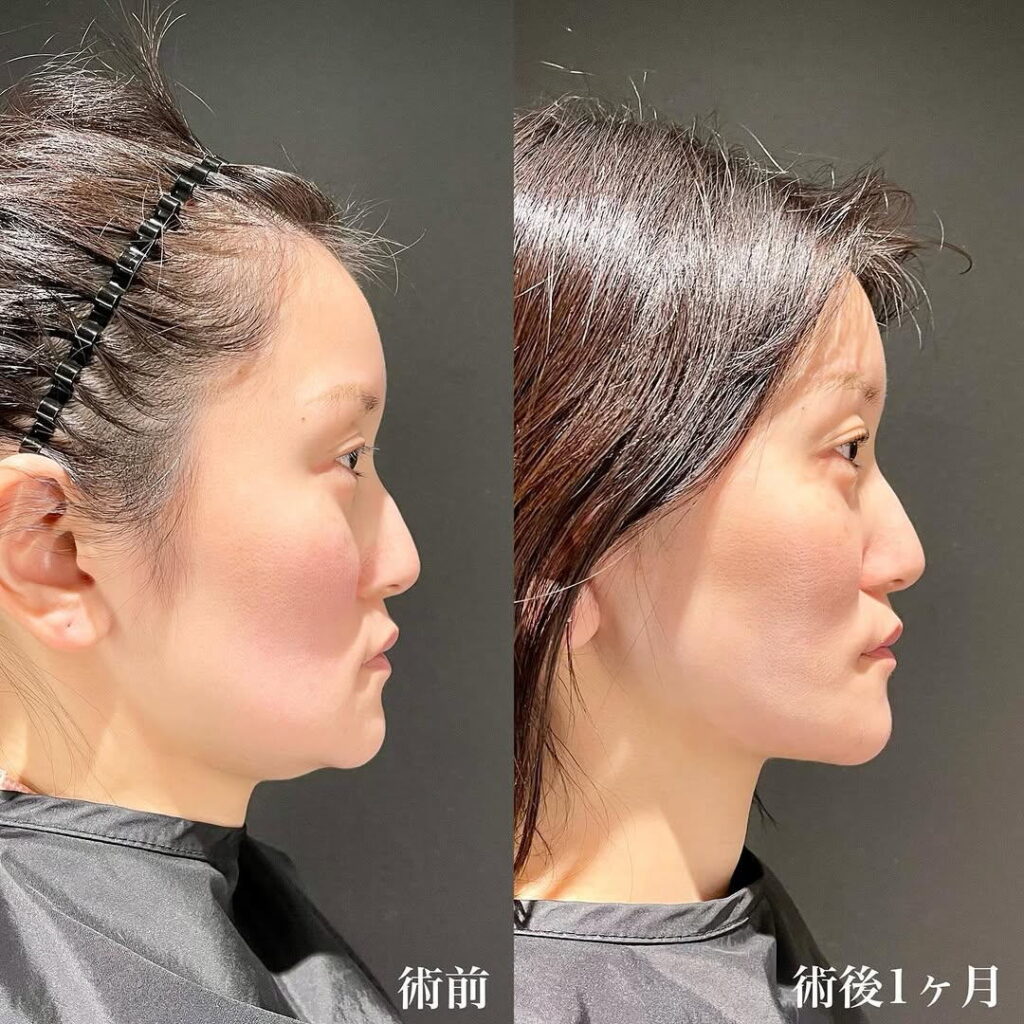 ペリカン手術 症例