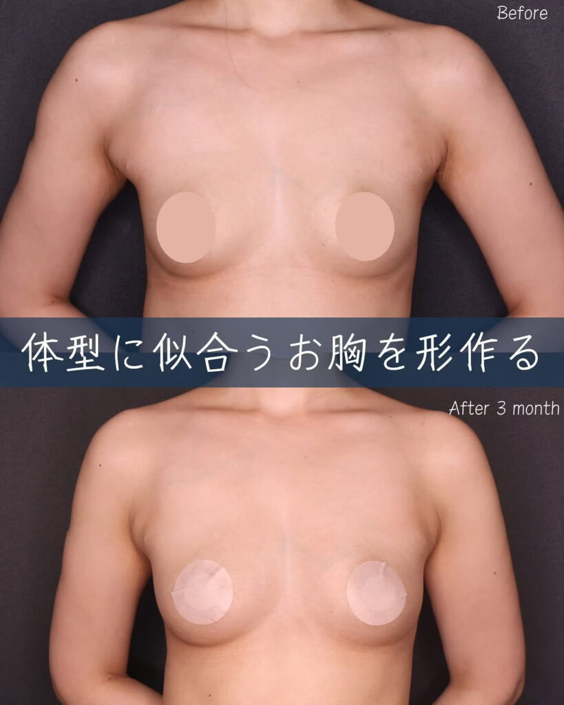 コンデンスリッチ脂肪注入豊胸 症例
