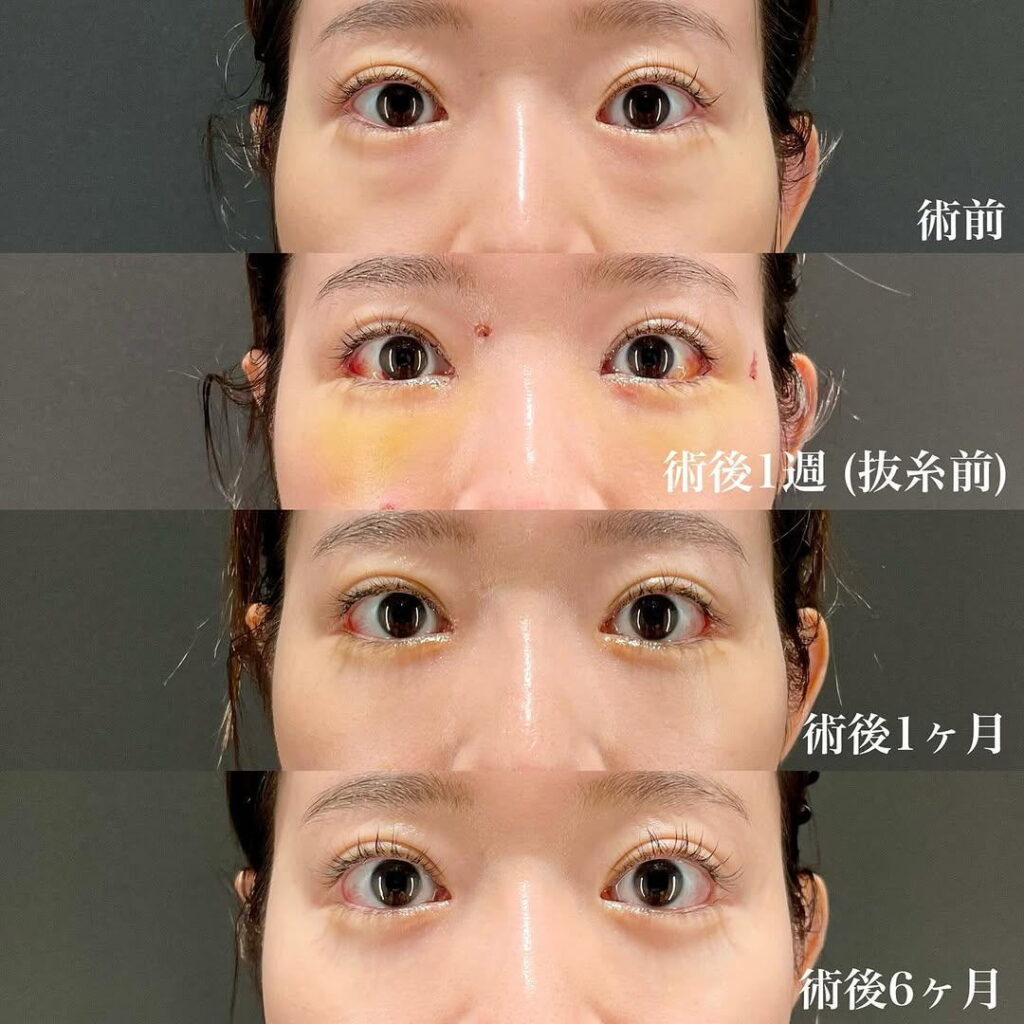 白目拡大術 裏ハムラ リドレープ 目頭切開 症例