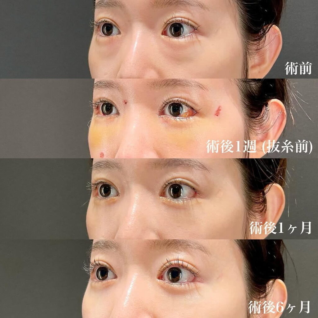白目拡大術 裏ハムラ リドレープ 目頭切開 症例