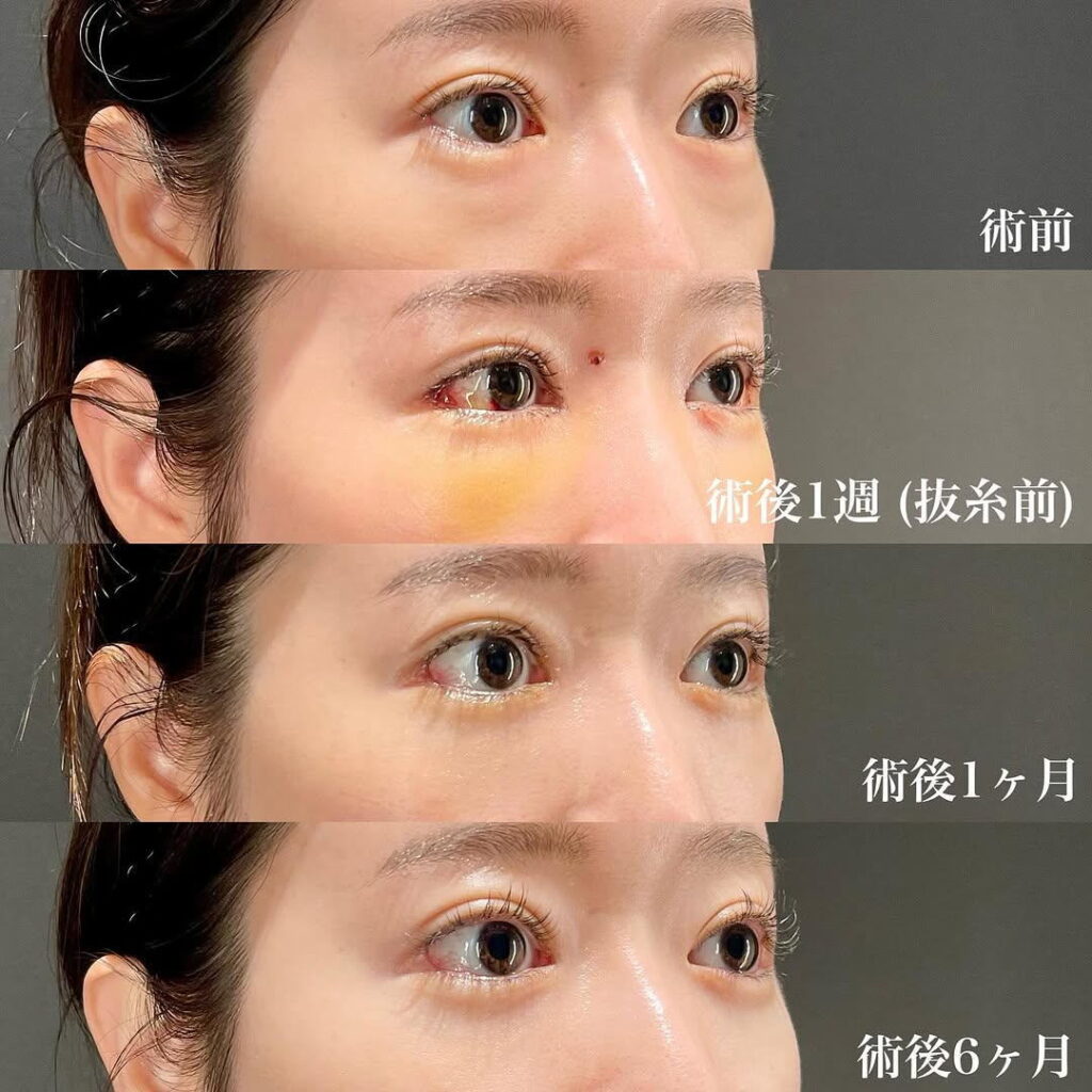 白目拡大術 裏ハムラ リドレープ 目頭切開 症例