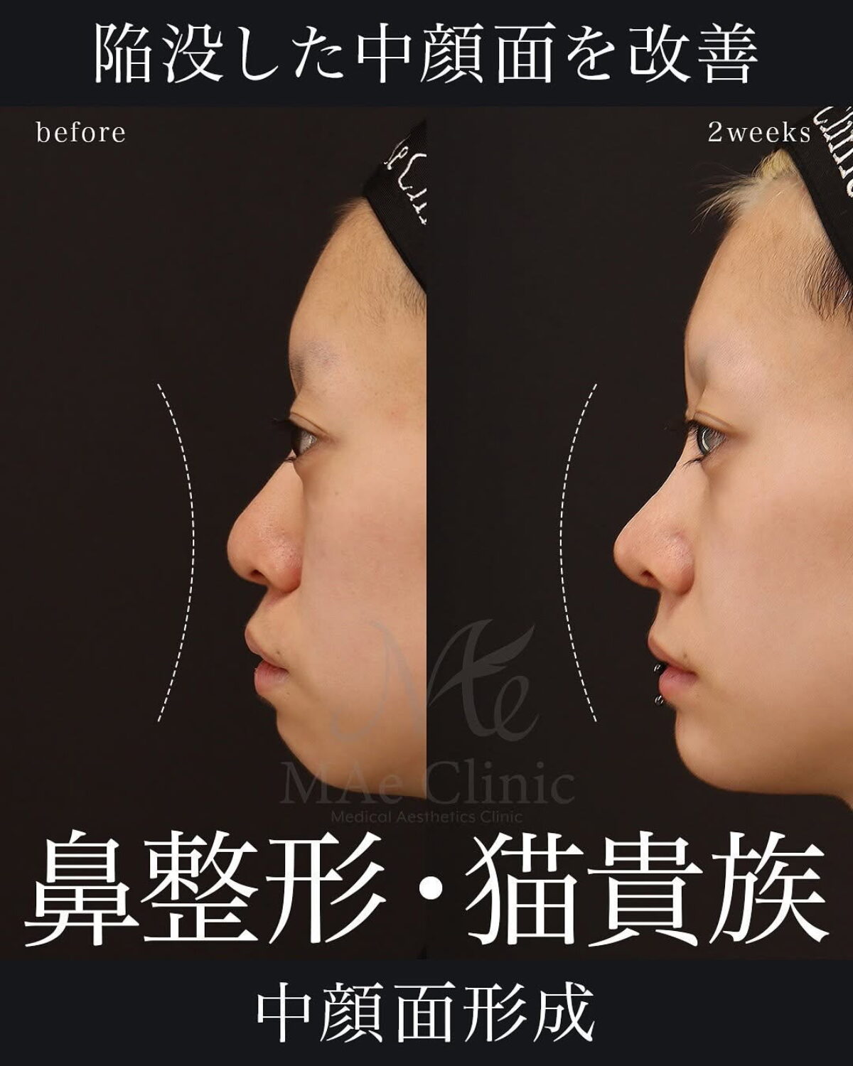 顔から姿勢を正す整顔術〜健美両立型のアプローチ〜 立体感をトータルで整える】中顔面の凹みを軸に考えた鼻整形症例