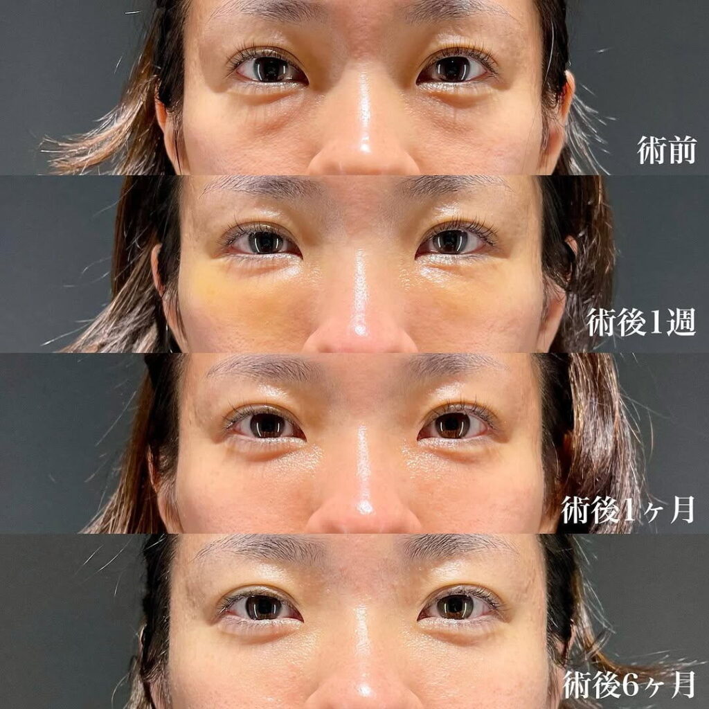 裏ハムラ 症例