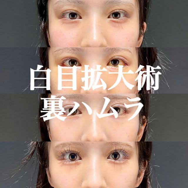 白目拡大術　裏ハムラ　症例