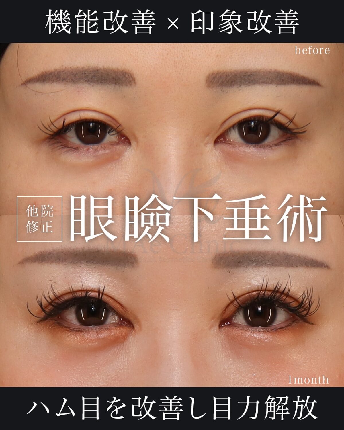 二重整形の修正はできる？他院全切開後の眼瞼下垂を改善した症例 | MAe