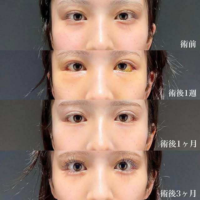 白目拡大術 裏ハムラ 症例