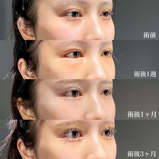 白目拡大術 裏ハムラ 症例