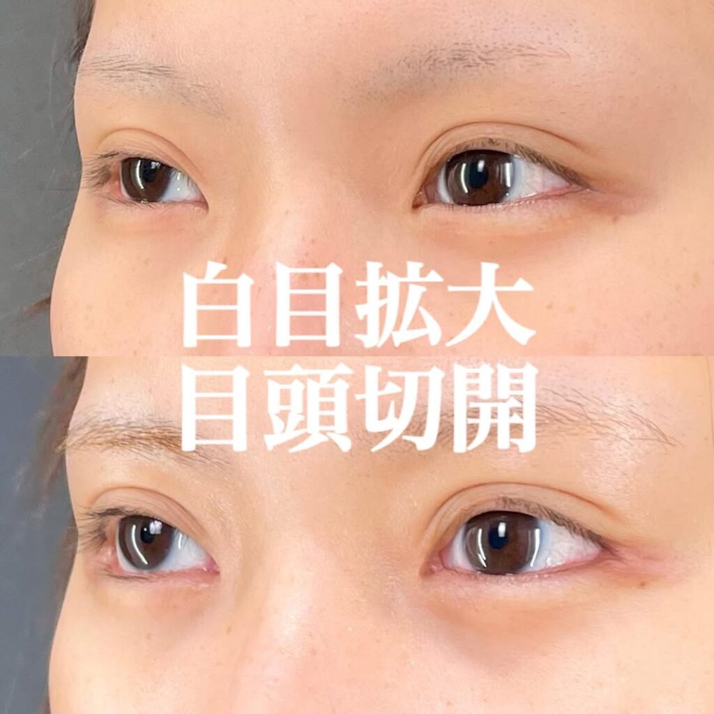 白目拡大術 目頭切開 症例