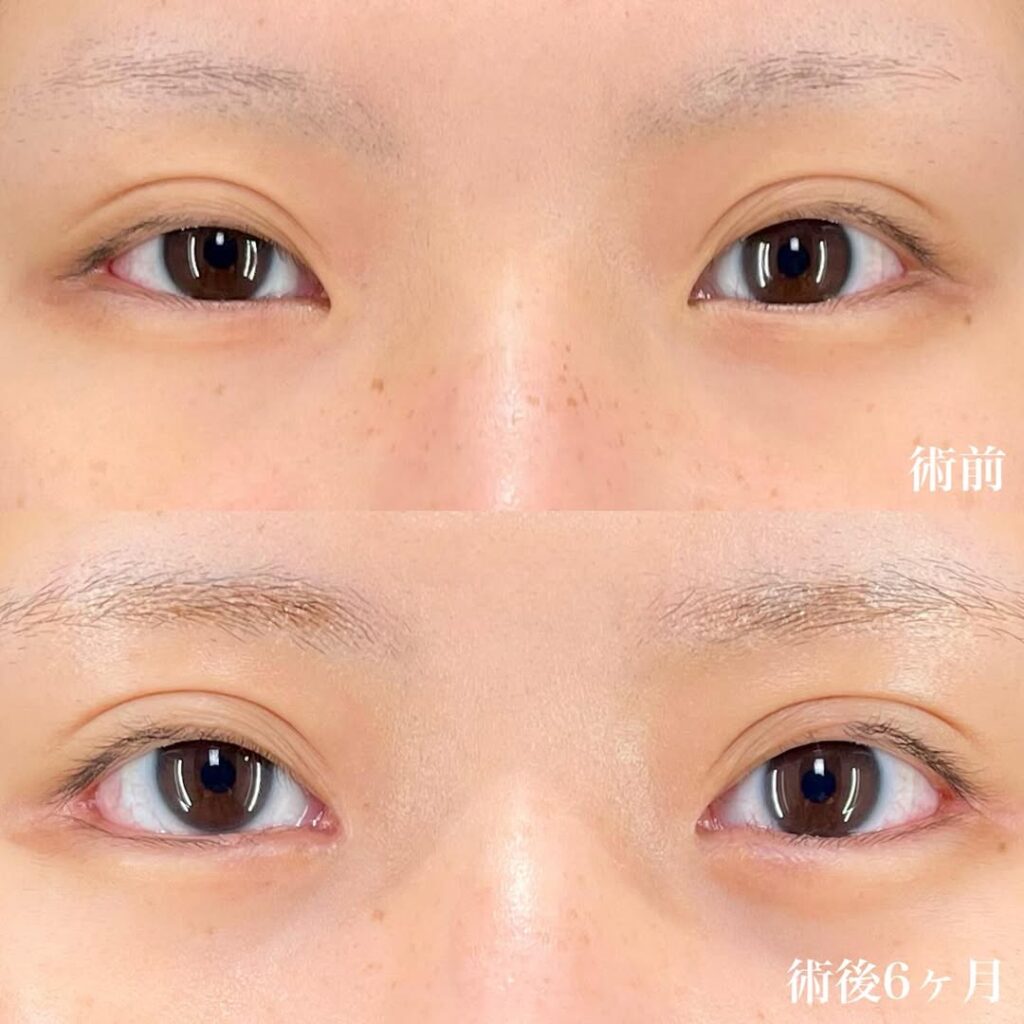 白目拡大術 目頭切開 症例