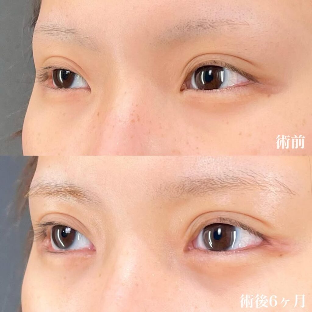 白目拡大術 目頭切開 症例