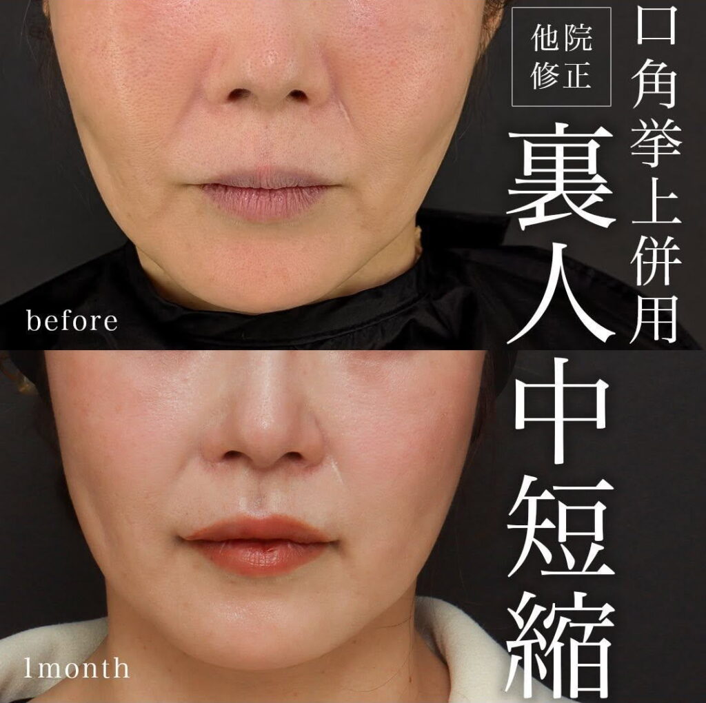 裏人中短縮 症例