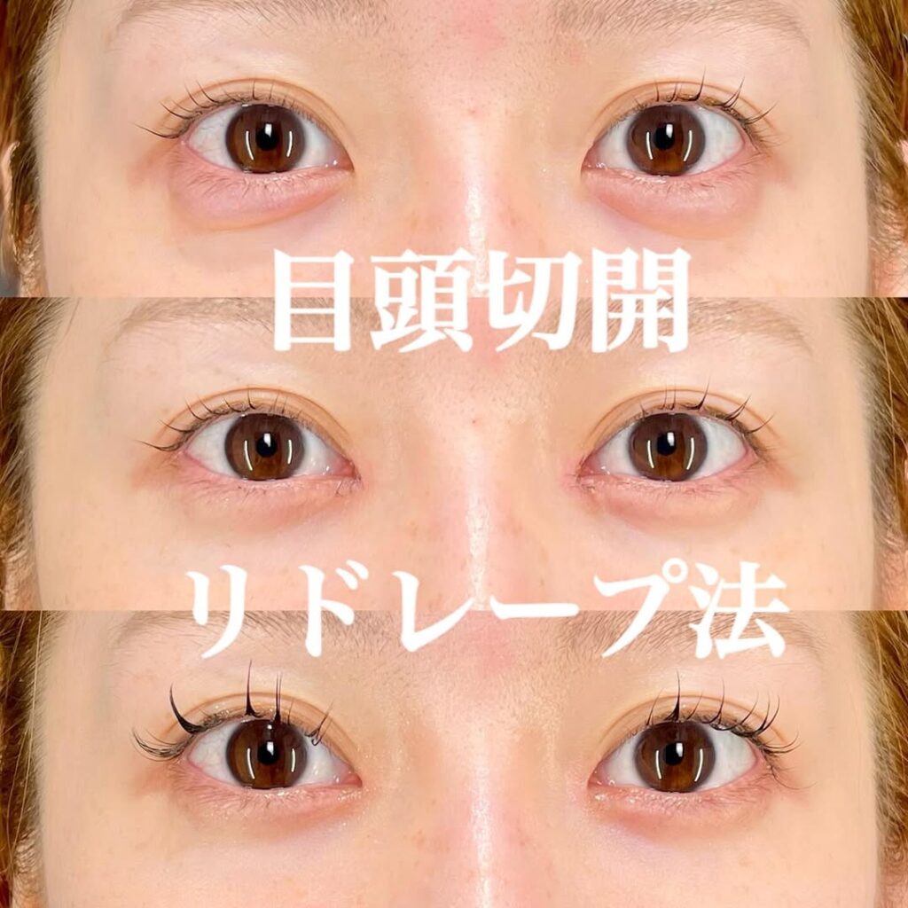 目頭切開リドレープ法 症例