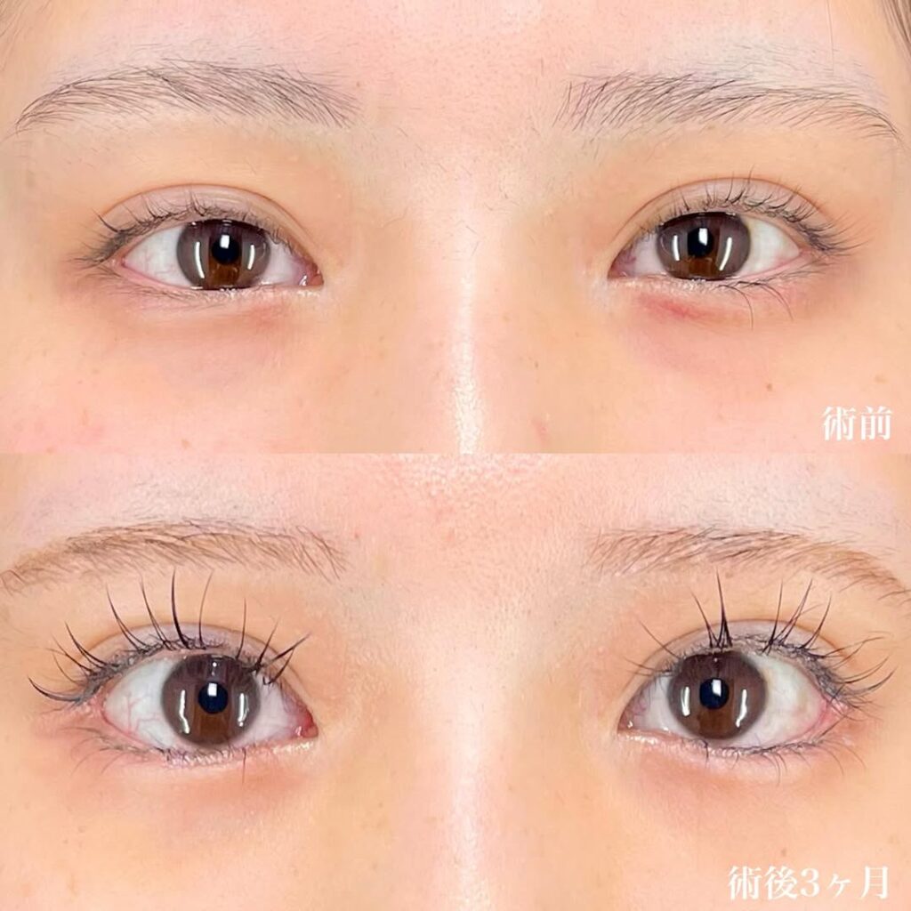 白目拡大術 裏ハムラ 症例