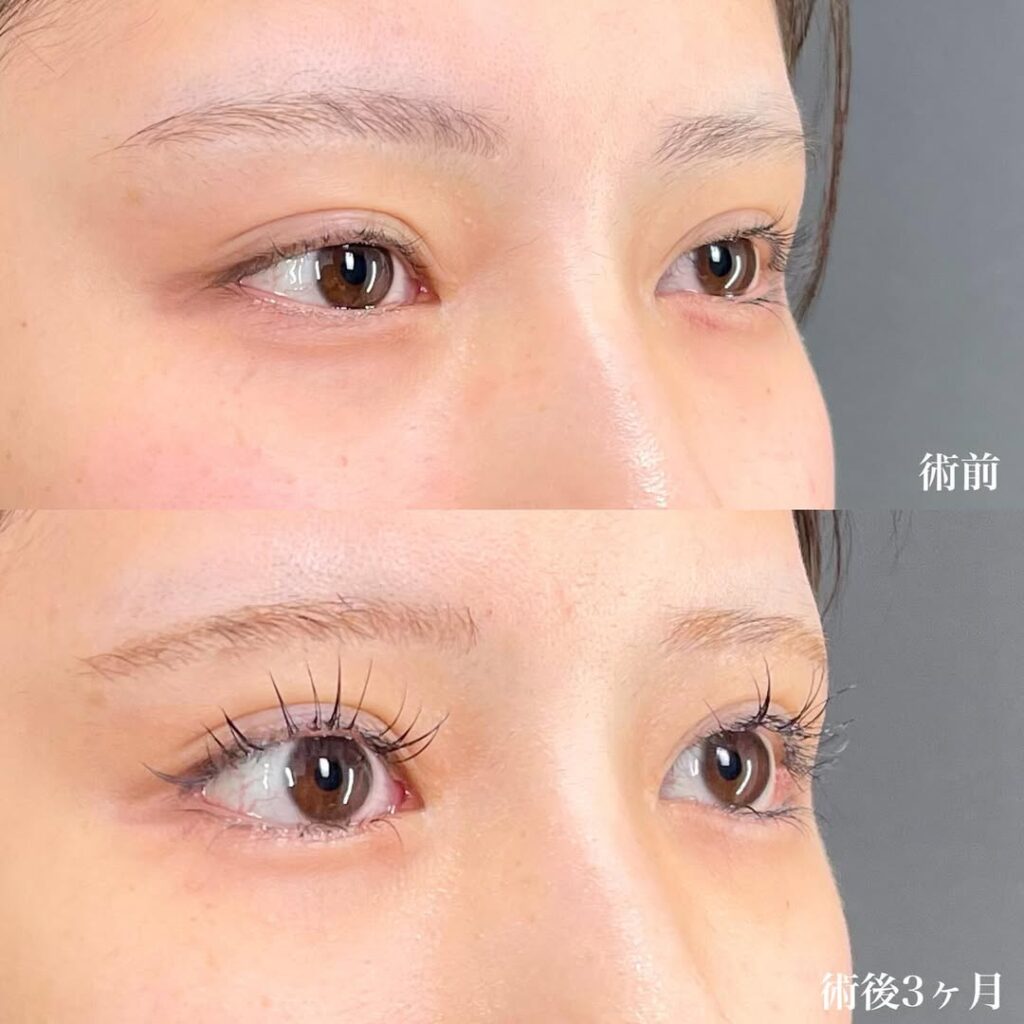 白目拡大術 裏ハムラ 症例