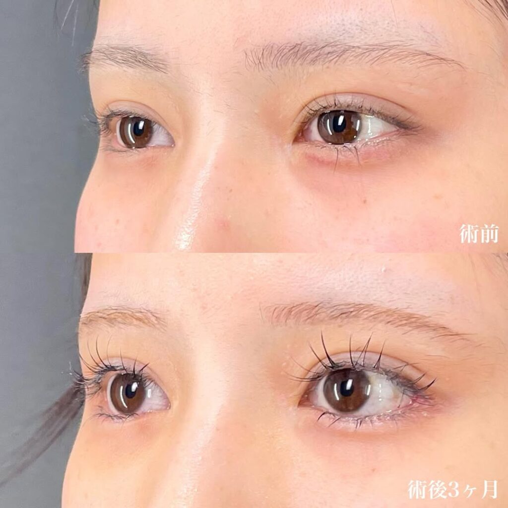 白目拡大術 裏ハムラ 症例