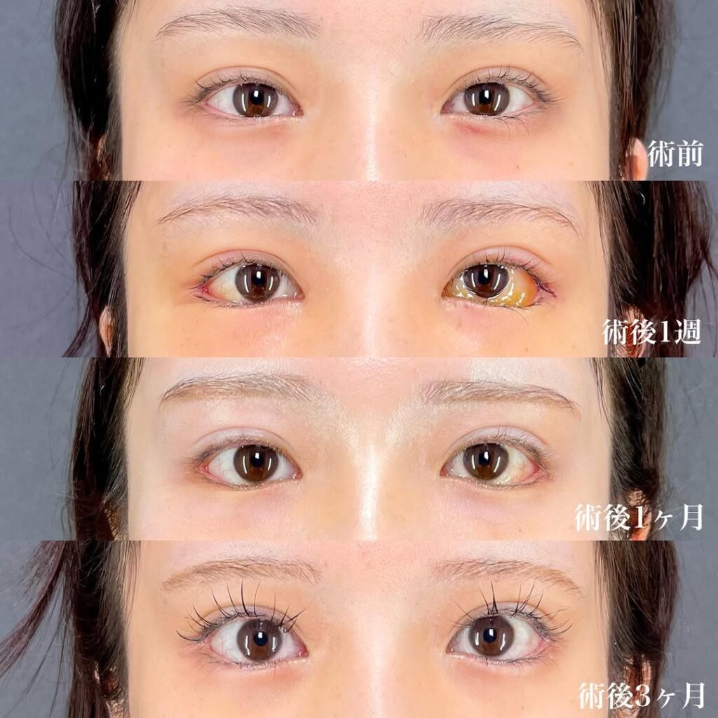 白目拡大術 裏ハムラ 症例