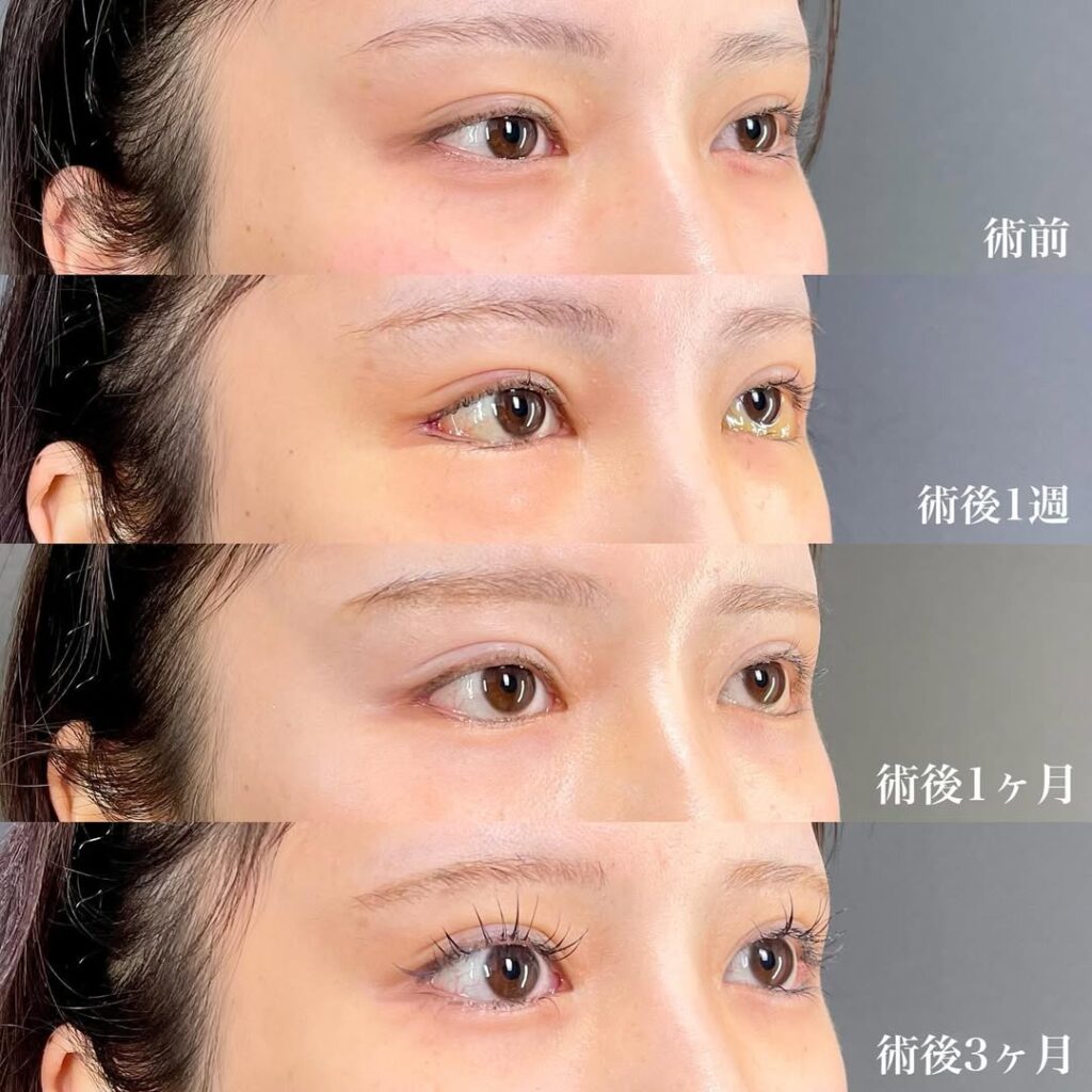 白目拡大術 裏ハムラ 症例