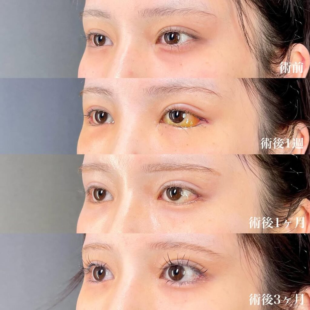 白目拡大術 裏ハムラ 症例