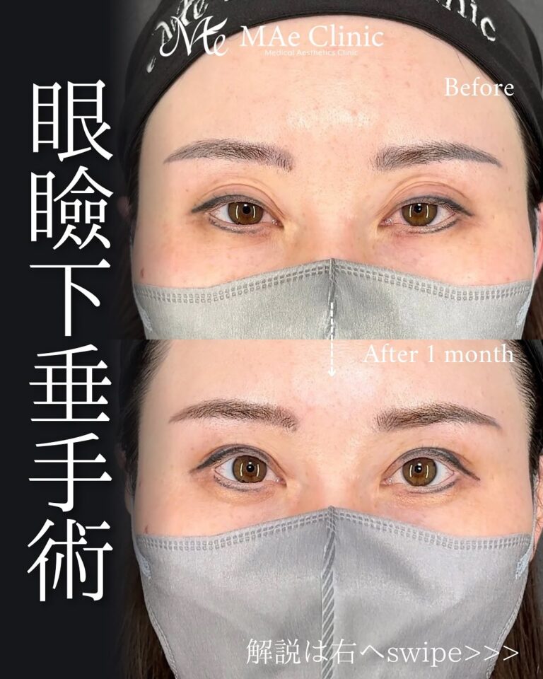 眠そうな目元を改善|眼瞼下垂手術+全切開で黒目の露出アップ | MAe Clinic【マエクリ】