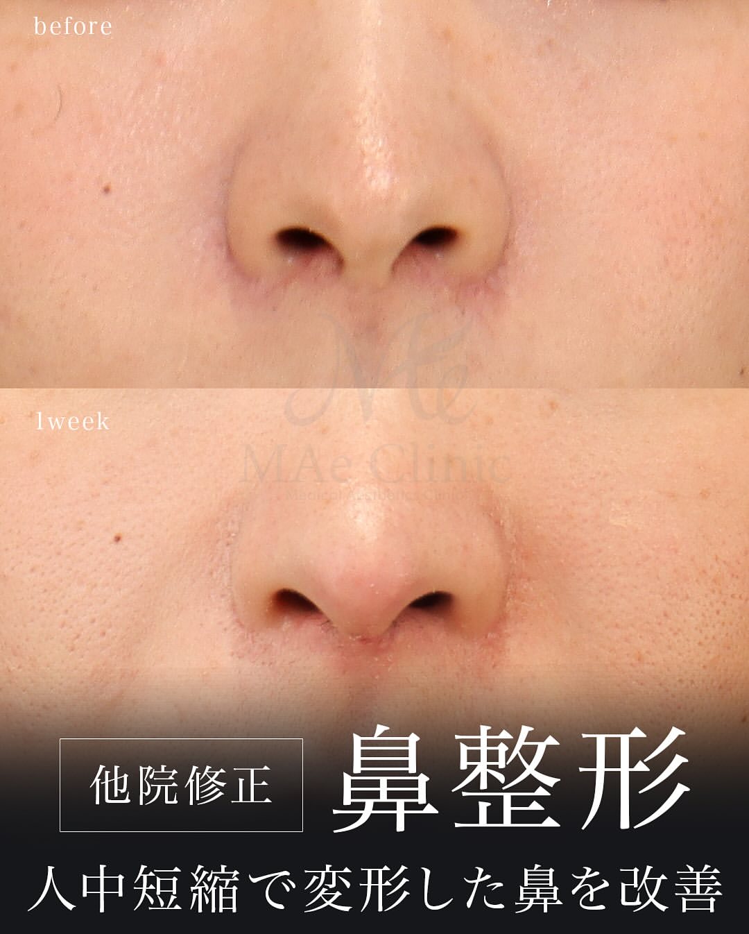 鼻形成術　裁断済み 2025052701.jpg