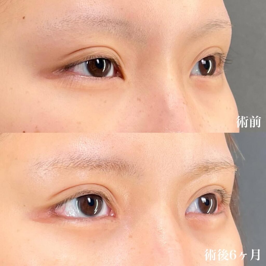 白目拡大術 目頭切開 症例