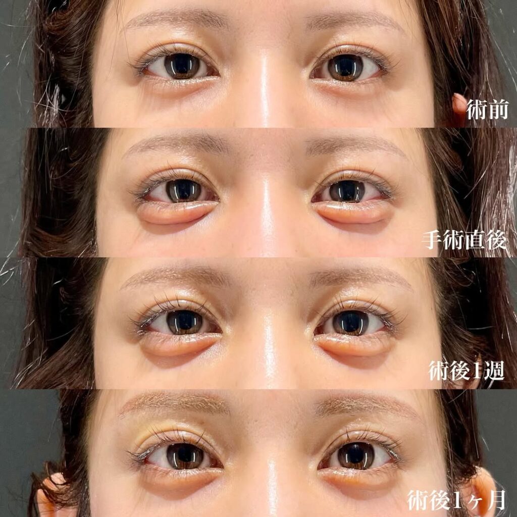 外科的涙袋形成 症例