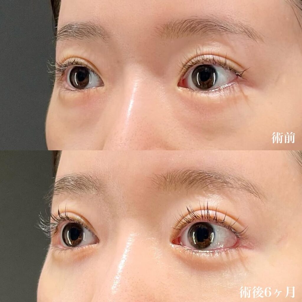 白目拡大術+裏ハムラ+目頭切開リドレープ法×術後6ヶ月