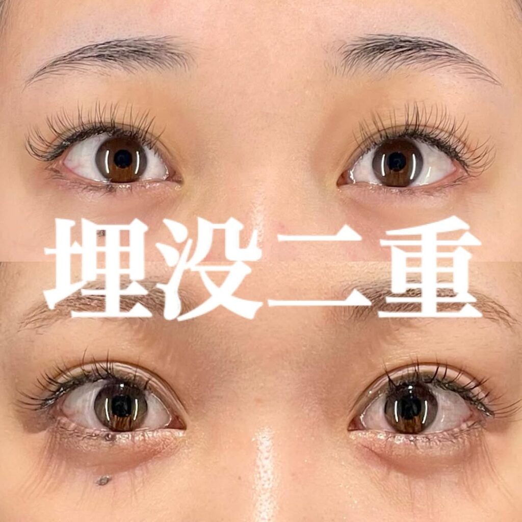 埋没二重(裏留め2ループ)×術後4ヶ月