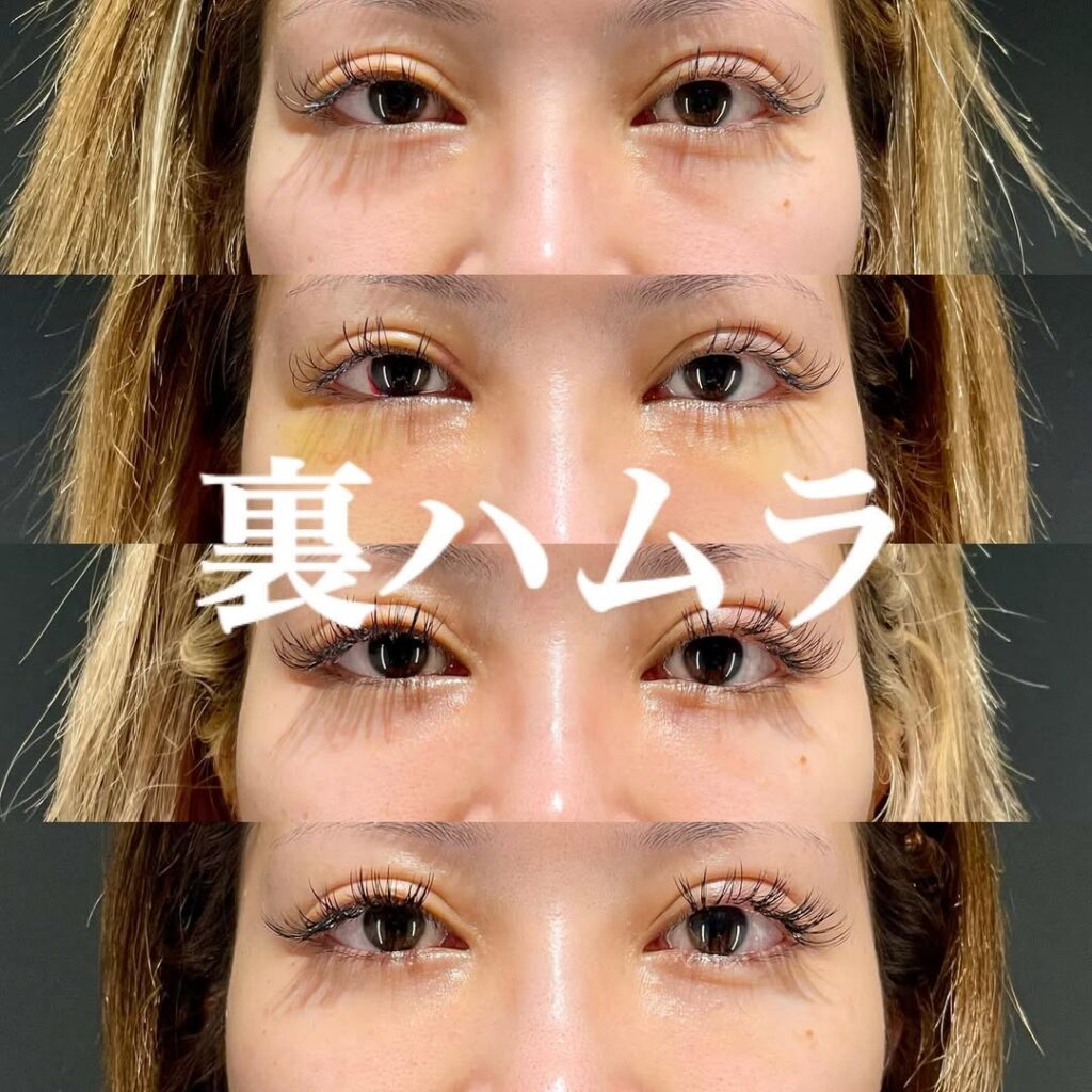 裏ハムラ×術後6ヶ月