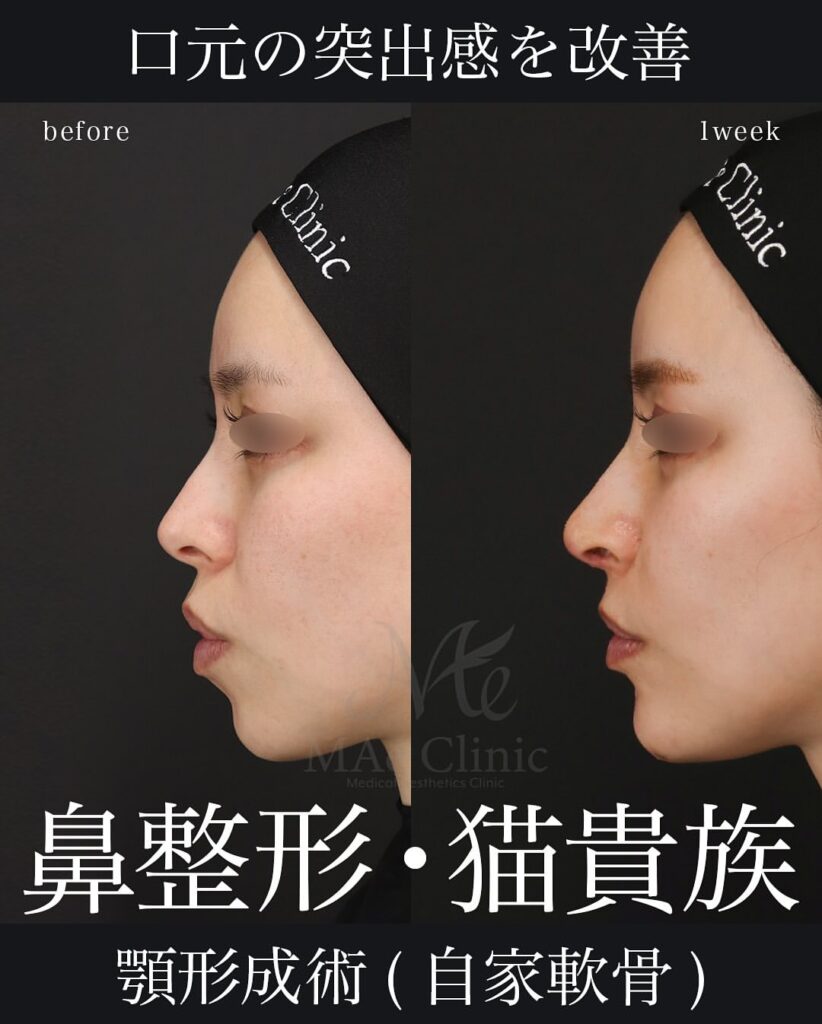 鼻中隔延長(肋軟骨)
鼻尖形成
鼻尖軟骨移植
猫手術(肋軟骨)
オステオポール除去
顎肋軟骨移植 症例