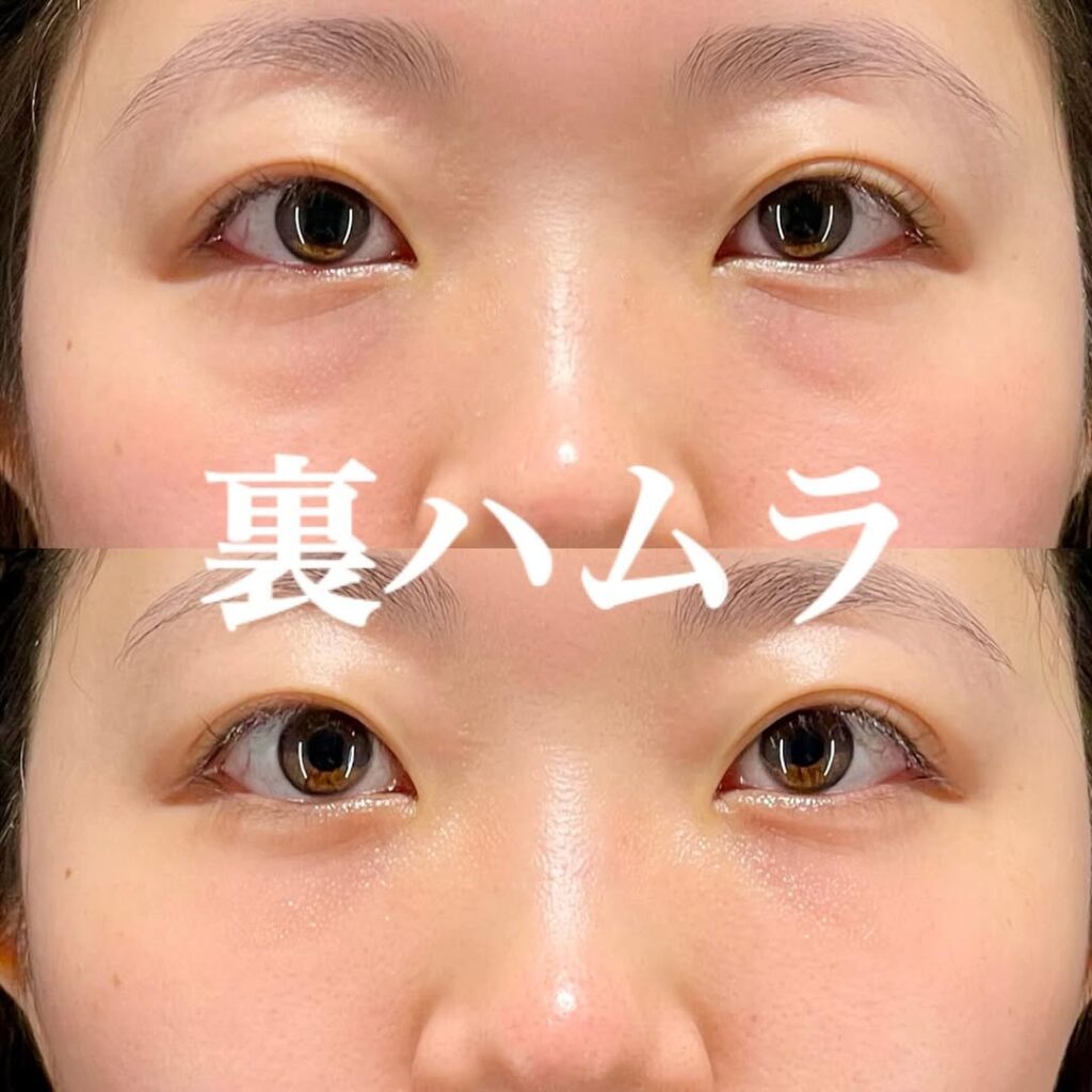 裏ハムラ 症例