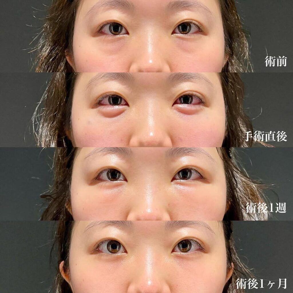 裏ハムラ 症例