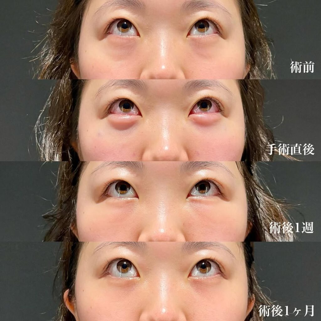 裏ハムラ 症例