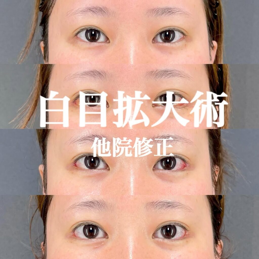 白目拡大術　症例