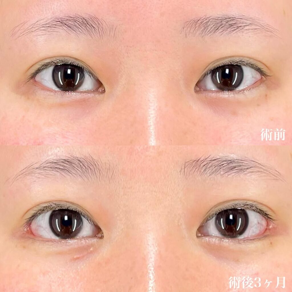 白目拡大術　症例