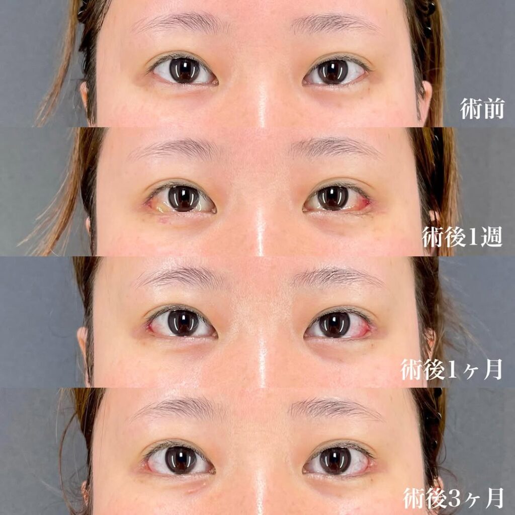 白目拡大術　症例