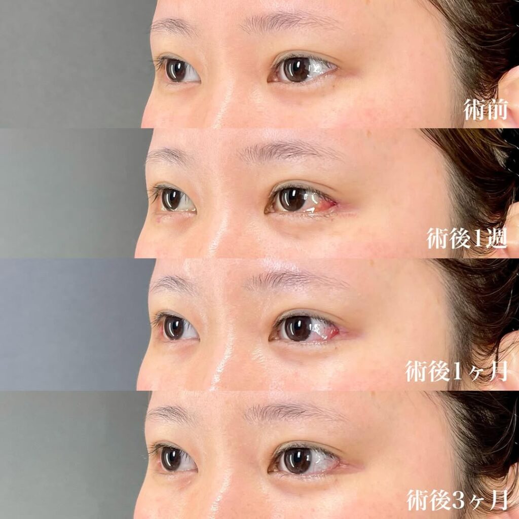 白目拡大術　症例