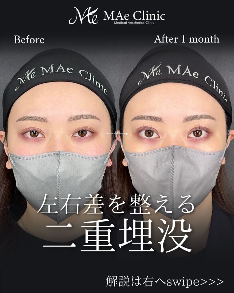 二重埋没症例