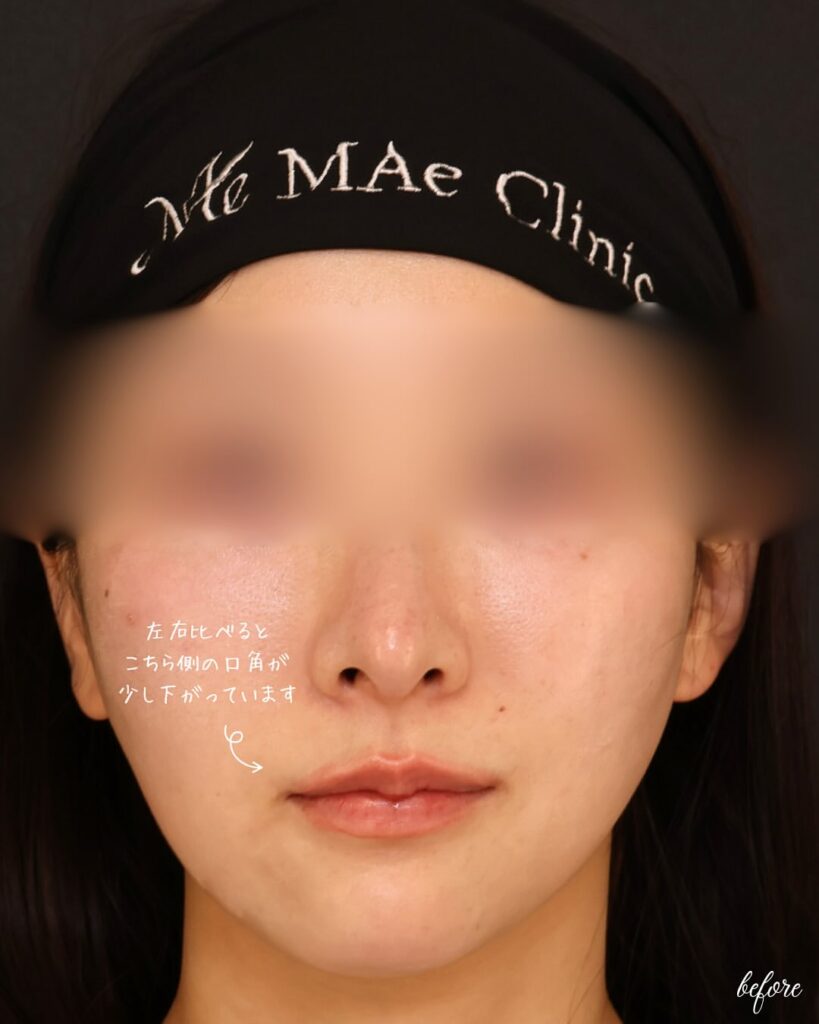 口角挙上(口角リフト)1ヶ月後の症例