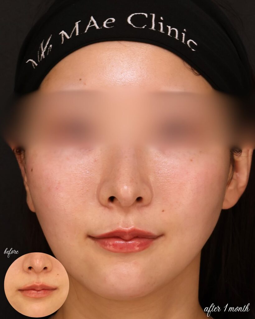 口角挙上(口角リフト)1ヶ月後の症例