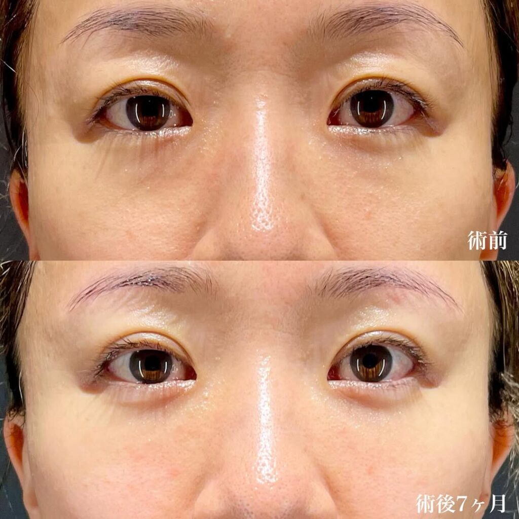 眉下切開 裏ハムラ 症例