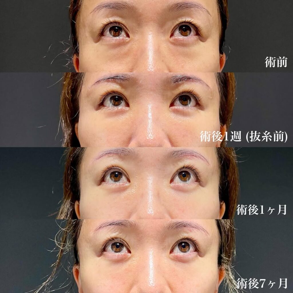 眉下切開 裏ハムラ 症例