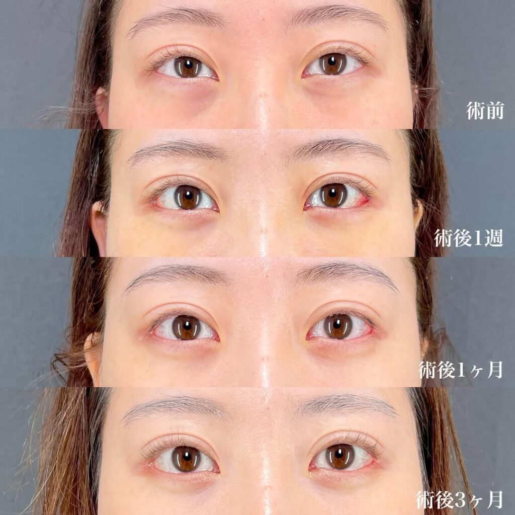 白目拡大術　裏ハムラ　症例