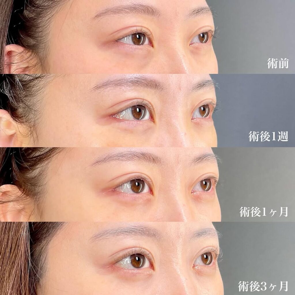 白目拡大術　裏ハムラ　症例