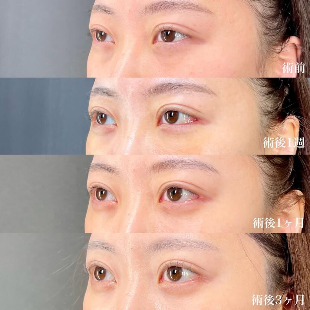白目拡大術　裏ハムラ　症例